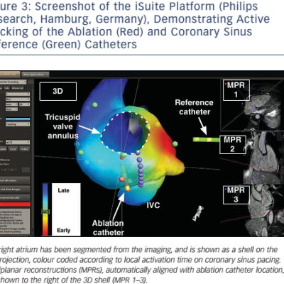 Figure 3 Screenshot of the iSuite Platform Philips Research Hamburg Germany Demonstrating Active Tracking of the Ablation Red and Coronary Sinus Reference Green Catheters