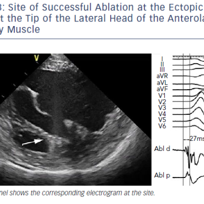 Site Of Successful Ablation At The Ectopic Focus At The Tip Of The Lateral Head