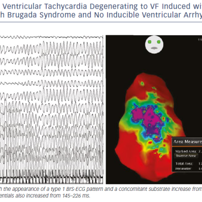 Sustained Polymorphic Ventricular Tachycardia Degenerating To VF