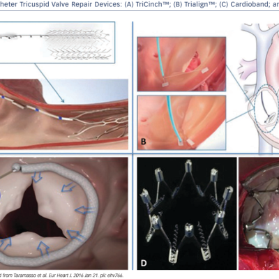 Figure 3 Transcatheter Tricuspid Valve Repair Devices A TriCinch™ B Trialign™ C Cardioband and D Millipede