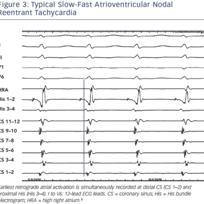 Figure 3 Typical Slow-Fast Atrioventricular Nodal Reentrant Tachycardia
