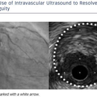 Figure 3 Use of Intravascular Ultrasound to Resolve Proximal Cap Ambiguity