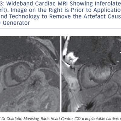 Wideband Cardiac MRI Showing Inferolateral Scar left. Image on the Right is Prior to Application of Wideband Technology to Remove the Artefact Caused by the ICD Generator