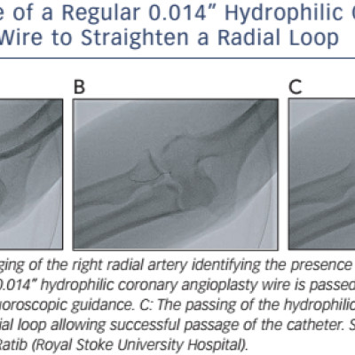Figure 3 Use of a Regular 0.014” Hydrophilic Coronary Angioplasty Wire to Straighten a Radial Loop