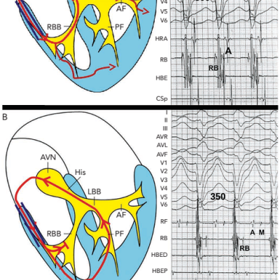 Figure 4 Change in QRS Morphology from Short to Long V-A Atrioventricular Re-entrant Tachycardia