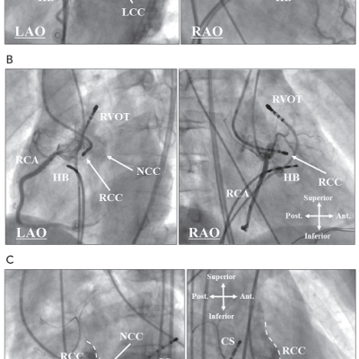 Figure-4-Coronary-angiograms-and-the-Catheter-positions