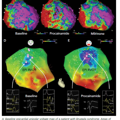 Epicardial Voltage Map Of The Right Ventricle