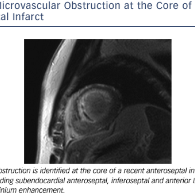 Figure 4 Microvascular Obstruction At The Core Of A Recent Anteroseptal Infarct