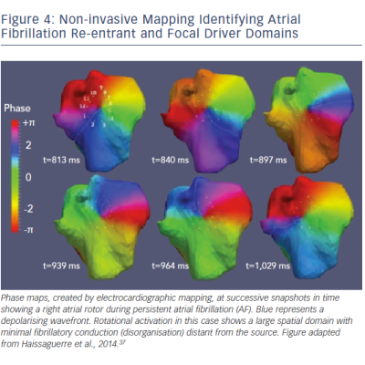 Non-invasive Mapping Indntifying AF Re-entrant &ampamp Focal Driver Domains