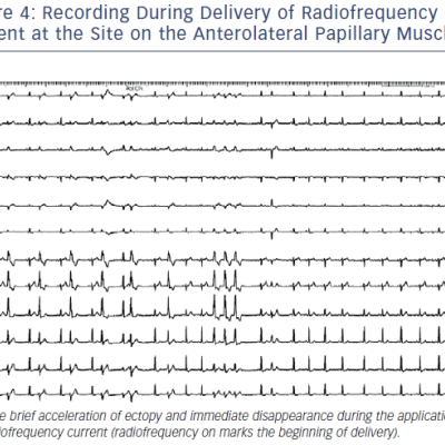 Recording During Delivery Of Radiofrequency Current At The Site