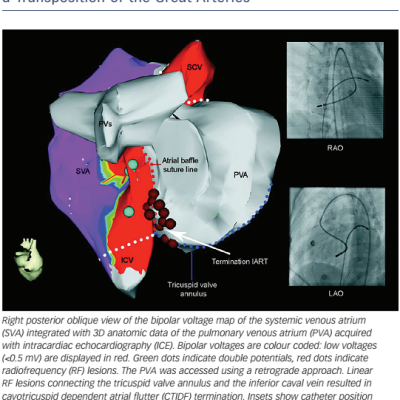 Figure 4 Retrograde Approach For Access To The Pulmonary Venous Atrium In A Patient With Cavotricuspid Dependent Atrial Flutter After A Senning Procedure For D-Transposition Of The Great Arteries