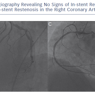 Six-Month Follow-Up Control Angiography