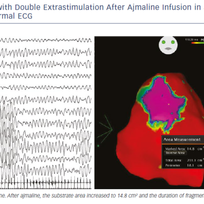 Sustained VF Induced With Double Extrastimulation
