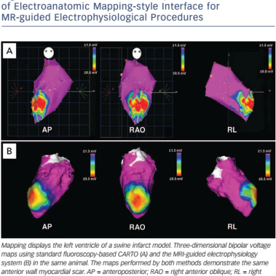 Figure 4 The First Published Example of Electroanatomic Mapping-style Interface for MR-guided Electrophysiological Procedures
