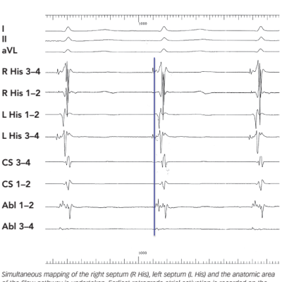 Figure 4 Typical Slow-Fast Atrioventricular Nodal Reentrant Tachycardia