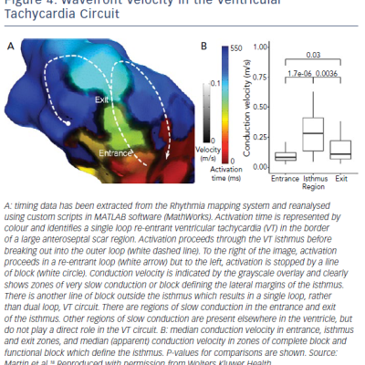 Wavefront Velocity In The Ventricular Tachycardia Circuit