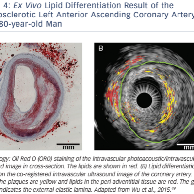 Figure 4 Ex Vivo Lipid Differentiation Result of the Atherosclerotic Left Anterior Ascending Coronary Artery of an 80-year-old Man