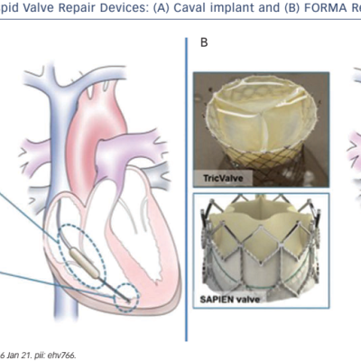 Figure 4 Transcatheter Tricuspid Valve Repair Devices A Caval implant and B FORMA Repair System device