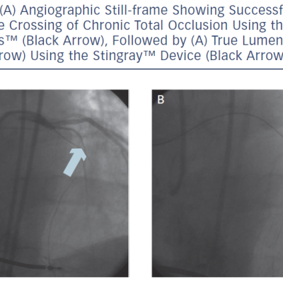 Figure 5 A Angiographic Still-frame Showing Successful Antegrade Crossing of Chronic Total Occlusion Using the CrossBossTM Black Arrow Followed by A True Lumen Re-entry White Arrow Using the StingrayTM Device Black Arrow