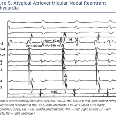 Figure 5 Atypical Atrioventricular Nodal Reentrant Tachycardia