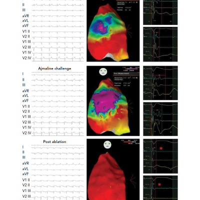 ECG And Epicardial Potential Duration Map At Baseline