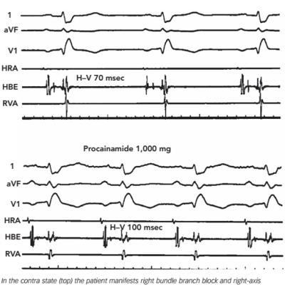 Figure 5 Effect of Procainamide on H-V Interval