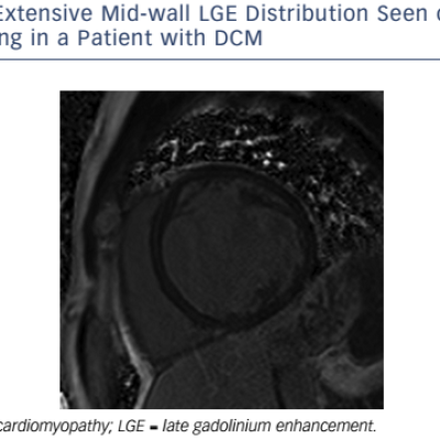 Figure 5 Extensive Mid-Wall LGE Distribution Seen On Shortaxis Imaging In A Patient With DCM