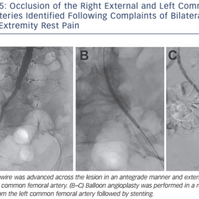 Figure 5 Occlusion of the Right External and Left Common Iliac Arteries Identified Following Complaints of Bilateral Lower Extremity Rest Pain