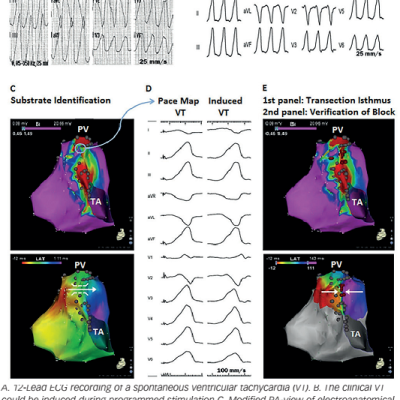 Figure 5 Procedural Workflow For Ablation Of A Haemodynamically Nontolerated Ventricular Tachycardia In A Patient After Repair Of Tetralogy Of Fallot