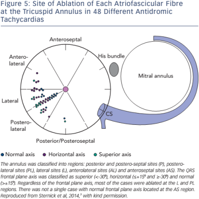 Figure 5 Site of Ablation of Each Atriofascicular Fibre at the Tricuspid Annulus in 48 Different Antidromic Tachycardias