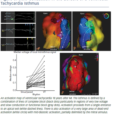 Slow Conduction In The Borders Of A Ventricular Tachycardia Isthmus