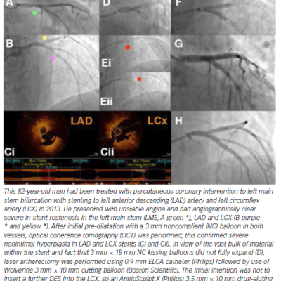 Treatment of Severe In-stent Restenosis in Left Main Stem Left Anterior Descending Artery and Left Circumflex Artery