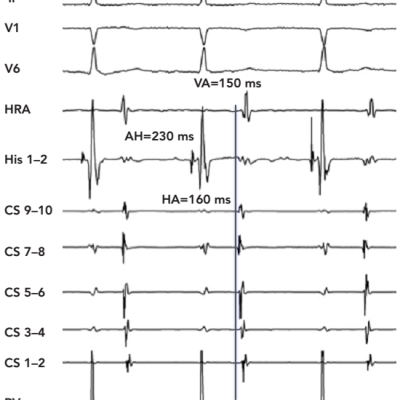 Figure 6 Atypical Atrioventricular Nodal Reentrant Tachycardia