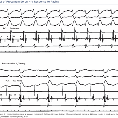 Figure 6 Effect of Procainamide on H-V Response to Pacing