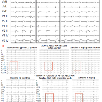 General Anaesthesia Attenuates Brugada ECG Pattern