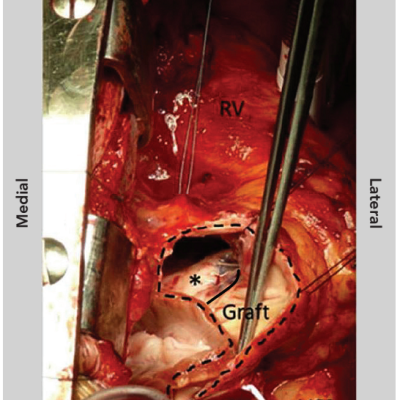 Figure 6 Interoperative View During Pulmonary Valve Replacement Using A Pulmonary Homograft In A Patient With Repaired Tetralogy Of Fallot