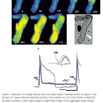 Figure 6 Large Extensive Ca2 Waves Lead to Sufficient Depolarisation to Elicit Nondriven APs