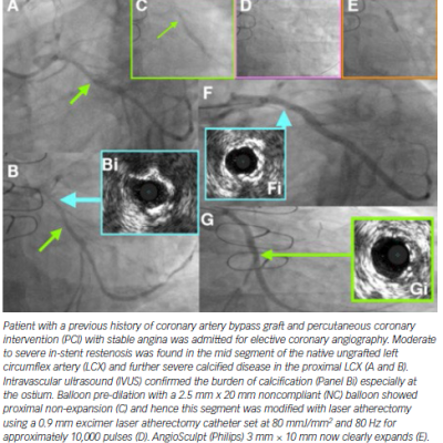 Stent Failure Secondary to Severe Calcification and Neo-atherosclerosis in Left Circumflex Artery