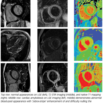 Figure 6 Multi-Parametric Assessment Of Normal Heart Cardiac Amyloidosis And Acute Myocarditis