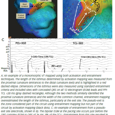 Comparison Of Activation And Pace Mapping Of The Ventricular Tachycardia Exit