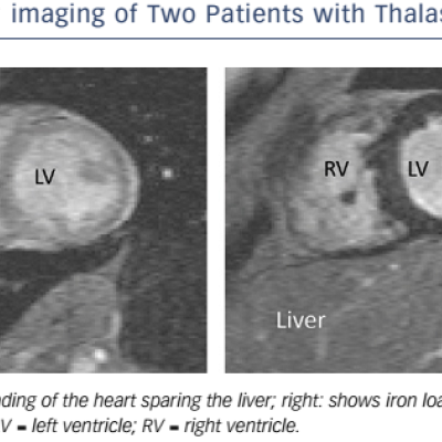 Figure 7 T2 Imaging Of Two Patients With Thalassaemia