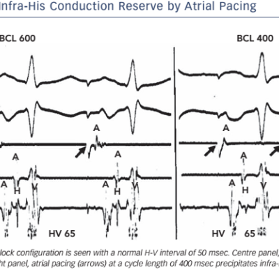 Figure 7 Unmasking of Decreased Infra-His Conduction Reserve by Atrial Pacing