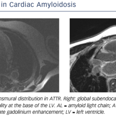 Figure 8 LGE In Cardiac Amyloidosis