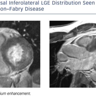 Figure 9 Basal Inferolateral LGE Distribution Seen In A Patient With Anderson–Fabry Disease