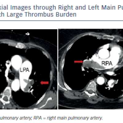 Figure 1 Axial Images through Right and Left Main Pulmonary Arteries with Large Thrombus Burden