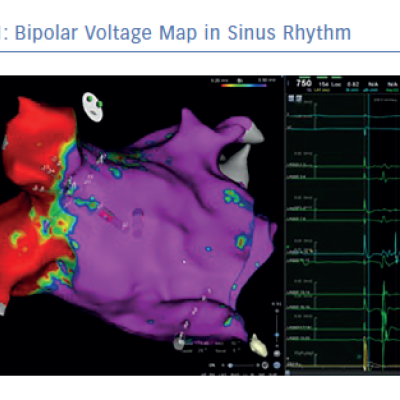 Bipolar Voltage Map in Sinus Rhythm