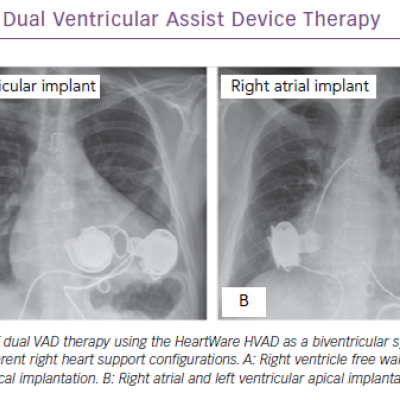 Dual Ventricular Assist Device Therapy
