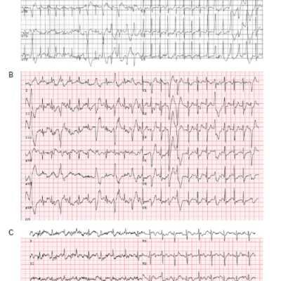 Figure 1 ECGs at Maximum Heart Rate During Exercise Testing Before and After Drug Treatments in a Female Patient with Catecholaminergic Polymorphic Ventricular Tachycardia