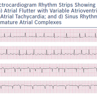 Figure 1 Electrocardiogram Rhythm Strips Showing a Atrial Fibrillation b Atrial Flutter with Variable Atrioventricular Block c Multifocal Atrial Tachycardia and d Sinus Rhythm with Frequent Premature Atrial Complexes