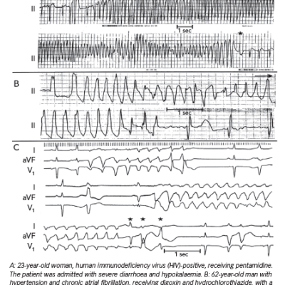 Electrocardiographic Examples of Acquired Long QT Syndrome LQTS and Torsade de Pointes TdP